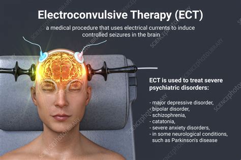 electroconvulsive treatment for depressive disorders